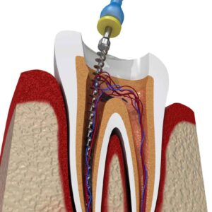 Endodoncia