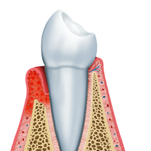 Periodoncia